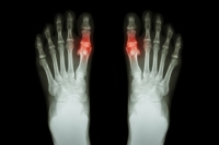 Understanding Gout and the Foods to Avoid