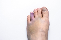 Types of Broken Toes
