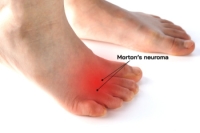 Symptoms That May Point to Morton’s Neuroma