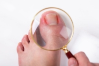 Understanding Ingrown Toenails and Finding Relief