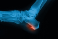 Heel Spurs Are a Common Cause of Persistent Heel Pain